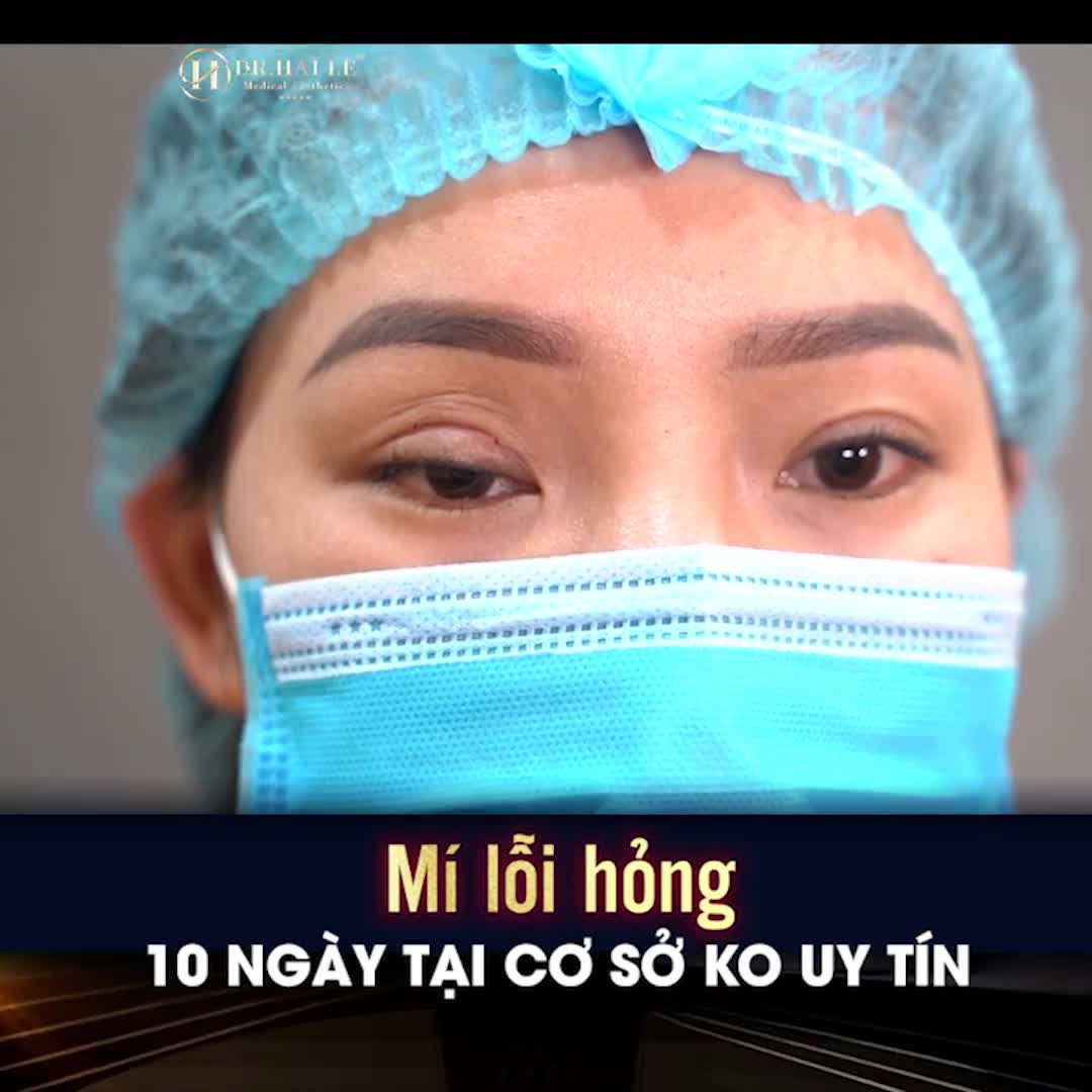 Nhiều khách hàng gọi điện cho Dr.Hải Lê hỏi mí em mới cắt ở cơ sở thẩm mỹ khác nhưng không ưng ý, nếp mí quá to, không đều, vết khâu chằng chịt giờ có sửa lại luôn được không?