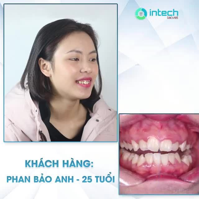 NIỀNG RĂNG GIÚP MÌNH ĐẾN GẦN HƠN VỚI GIẤC MƠ TRỞ THÀNH DANCER CHUYÊN NGHIỆP