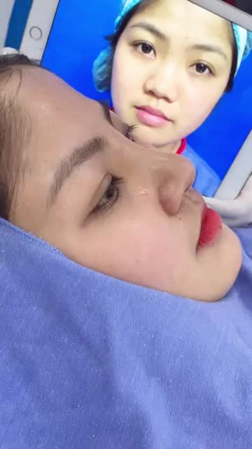 Quá trình cắt chỉ mũi sau 10 ngày phẫu thuật Nâng mũi cấu trúc 4D tại Kangnam