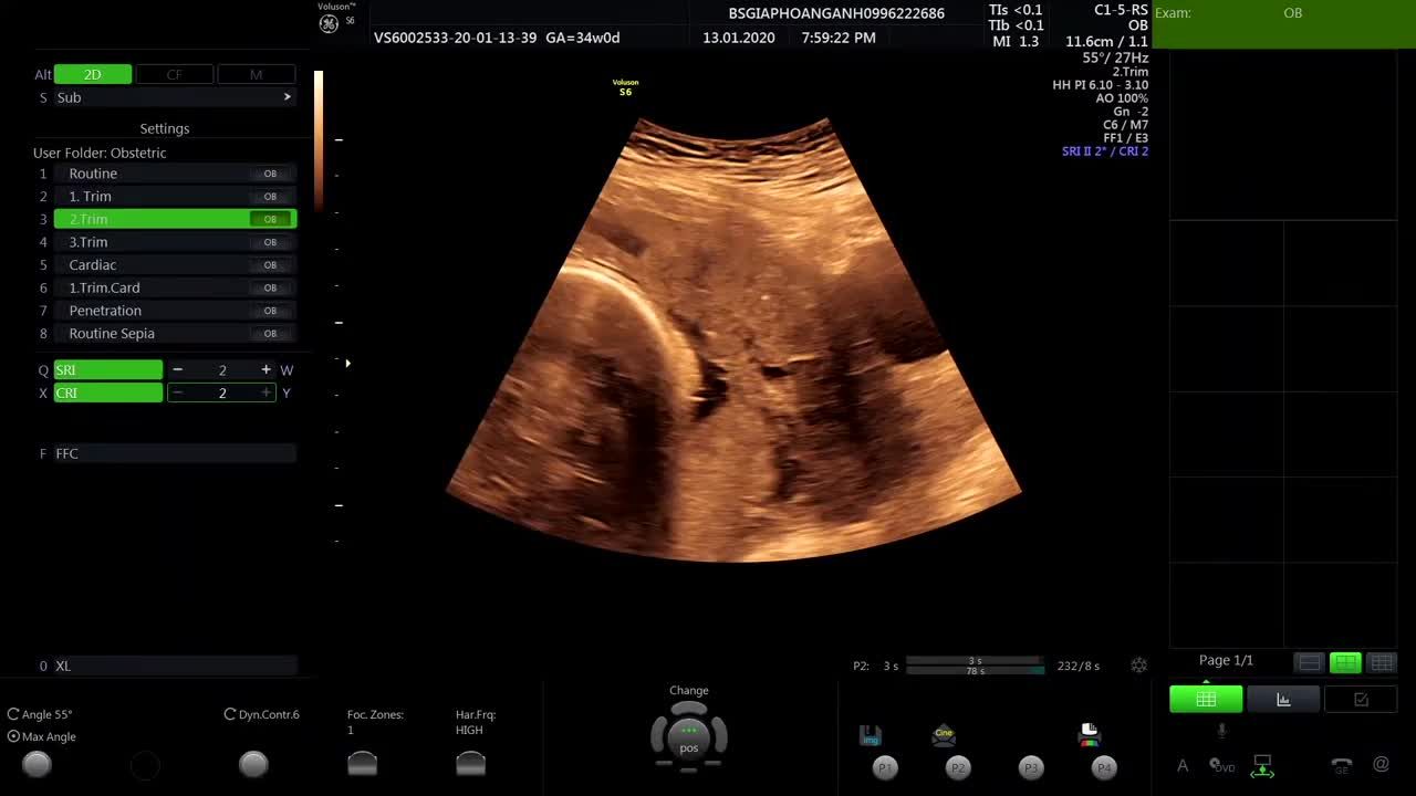 Rau cài răng lược, rau tiền đạo - Siêu âm thai BS Giáp Hoàng Anh