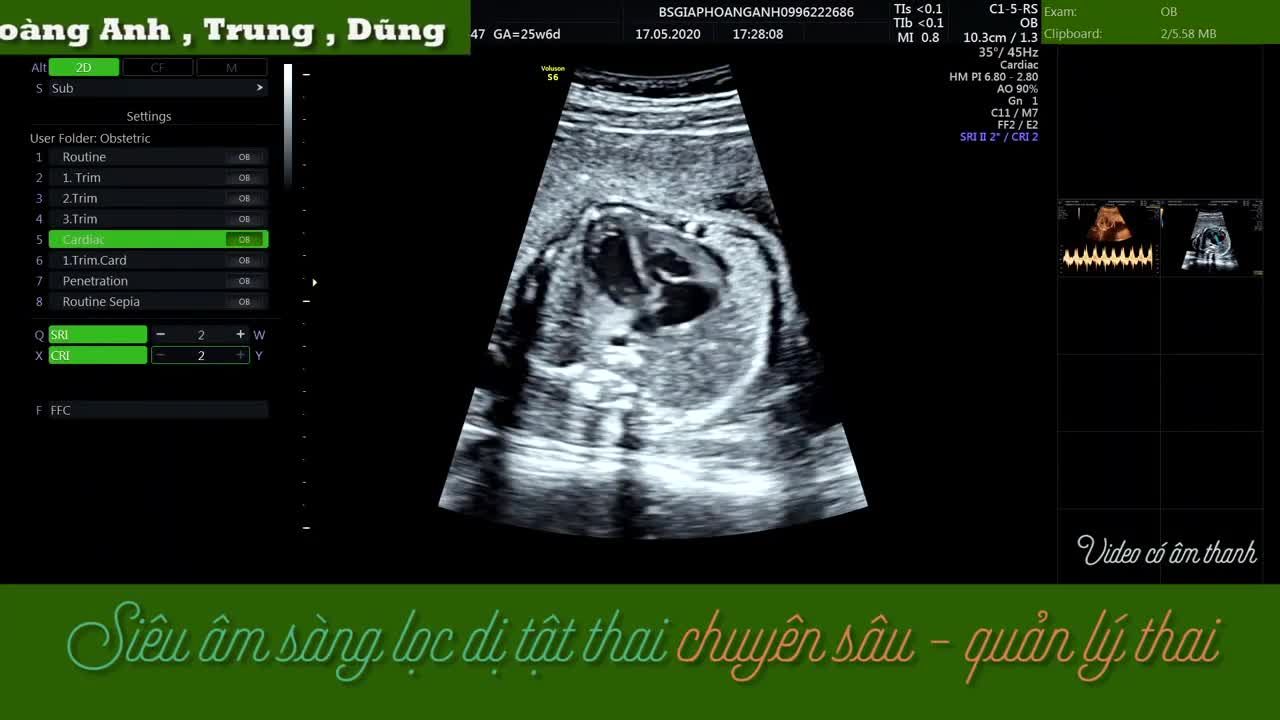 siêu âm thai​ bất thường van 3 là, van động mạch phổi tim thai