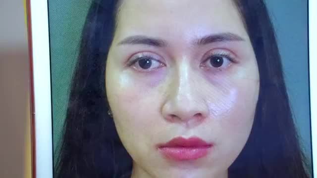 Sửa mí xong có đau nhiều không?