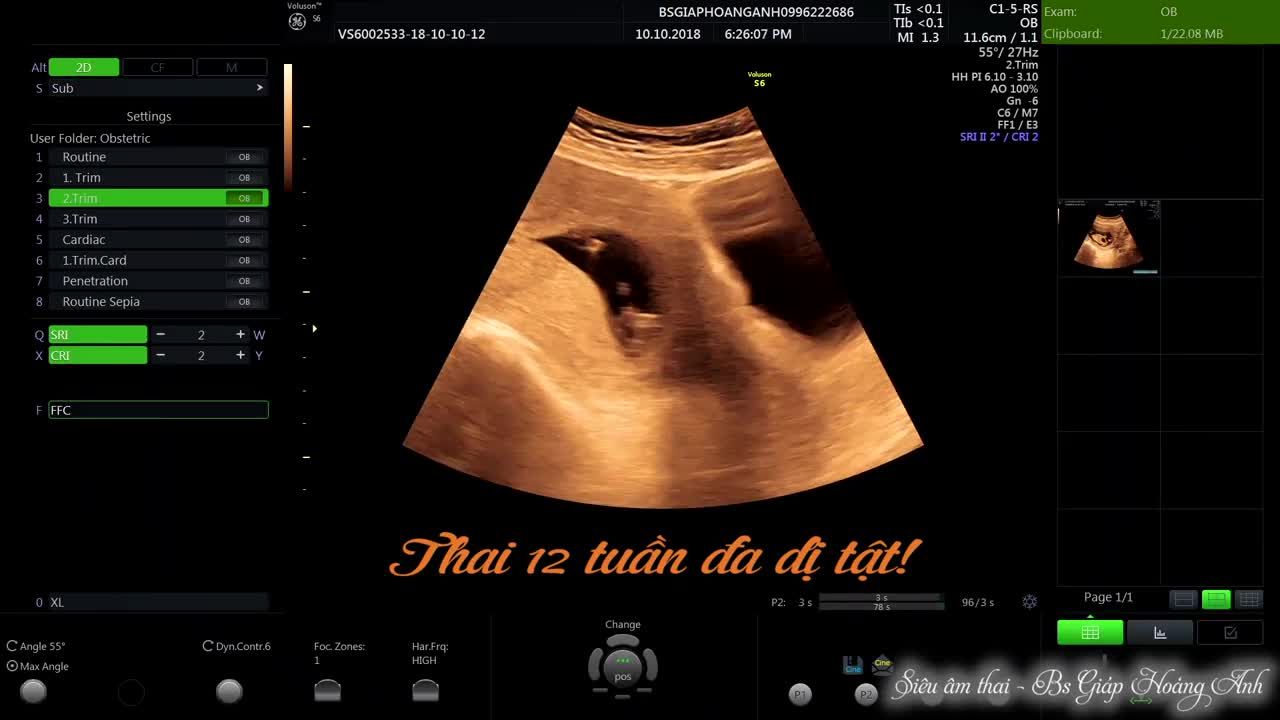 Thai 12 tuần đa dị tật 10/10/2018- SIêu âm thai - Bs Giáp Hoàng Anh