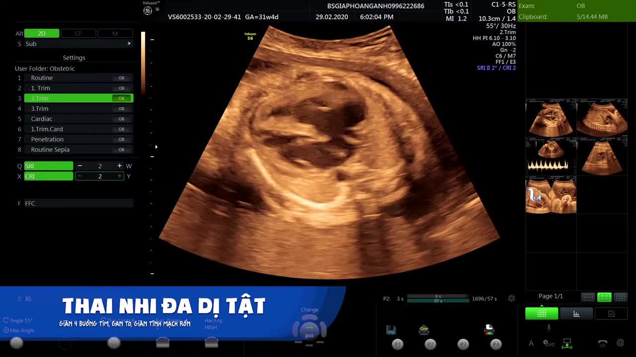 Thai 32w giãn 4 buồng tim, giãn tĩnh mạch rốn, gan to - Hệ thống PK Siêu âm thai - Bs Giáp Hoàng Anh