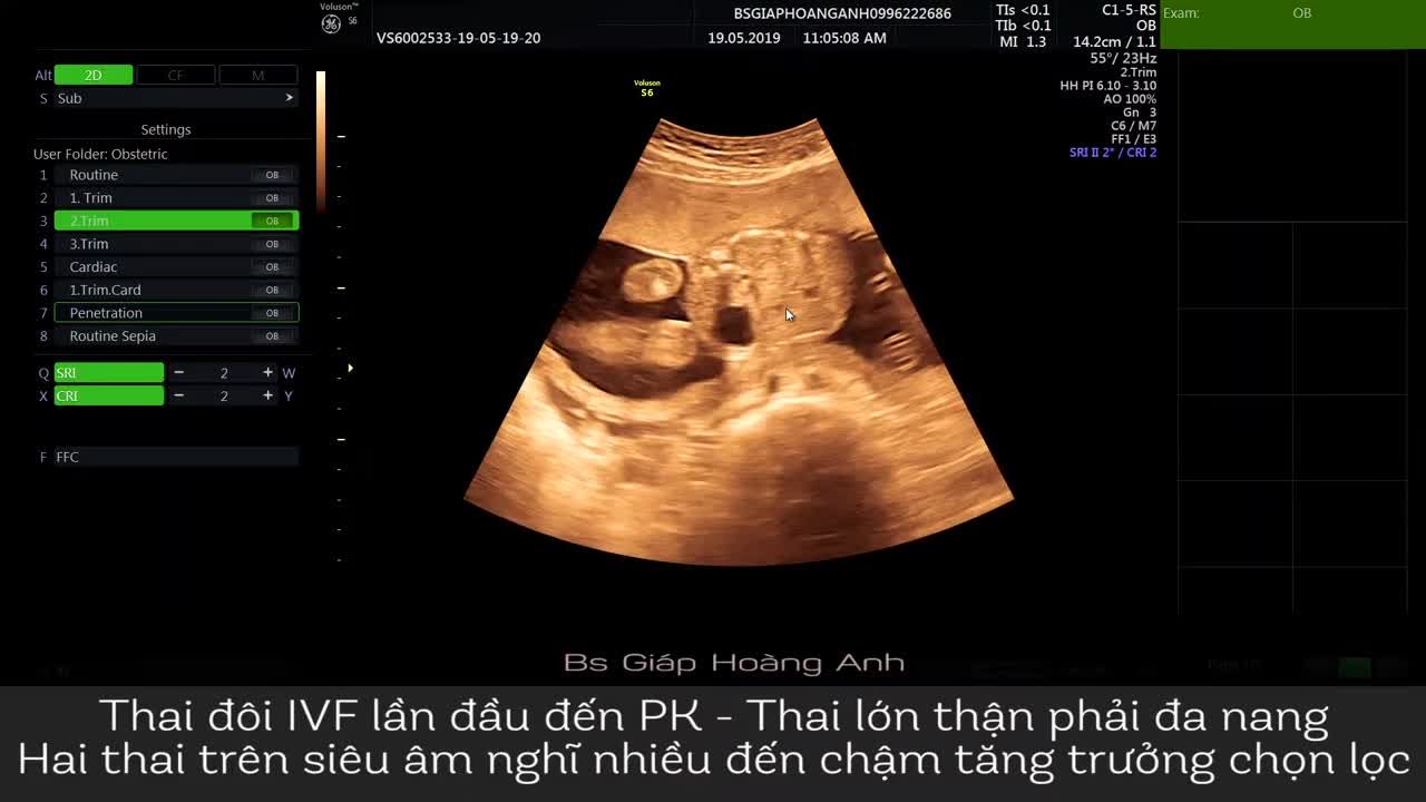 Thai đôi IVF thận đa nang - Hệ thống PK siêu âm thai Bs Giáp Hoàng Anh
