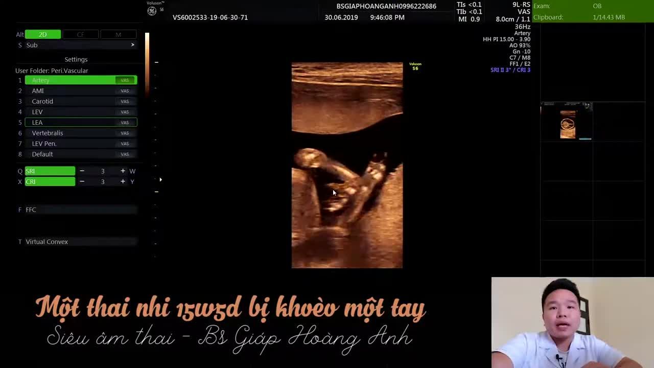 Thai nhi 15 tuần bị khoèo tay - Siêu âm thai Hoàng Anh Bắc Giang