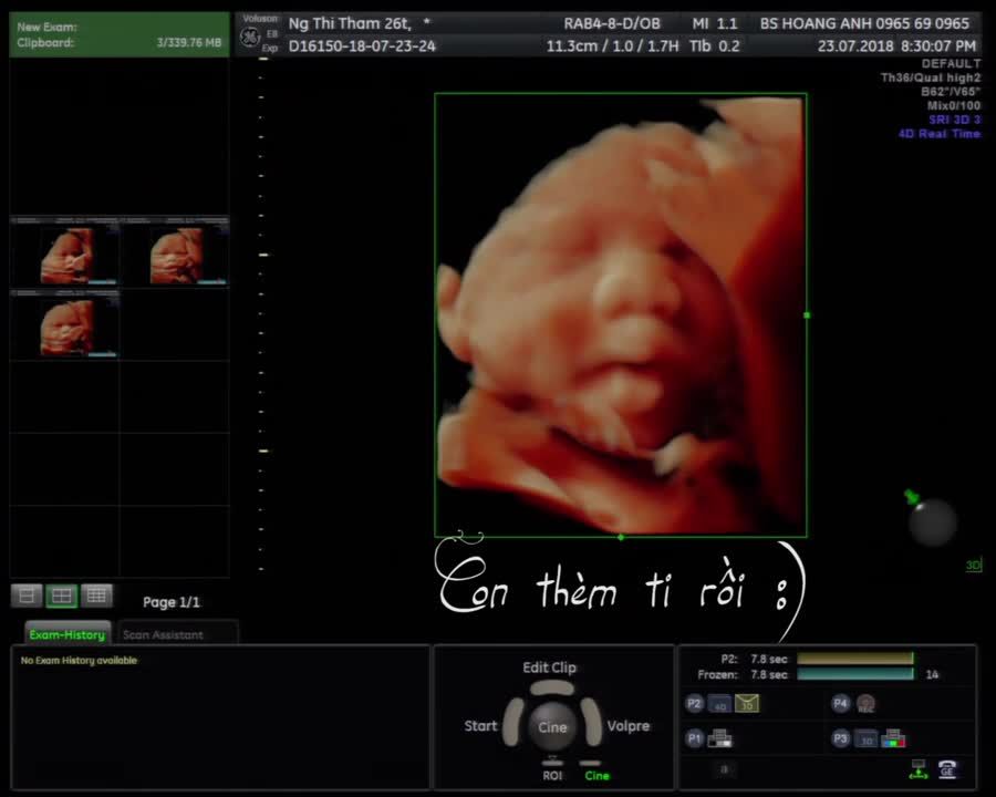 Thai nhi thèm ti từ trong bụng - Siêu âm thai - Bác sĩ Giáp Hoàng Anh