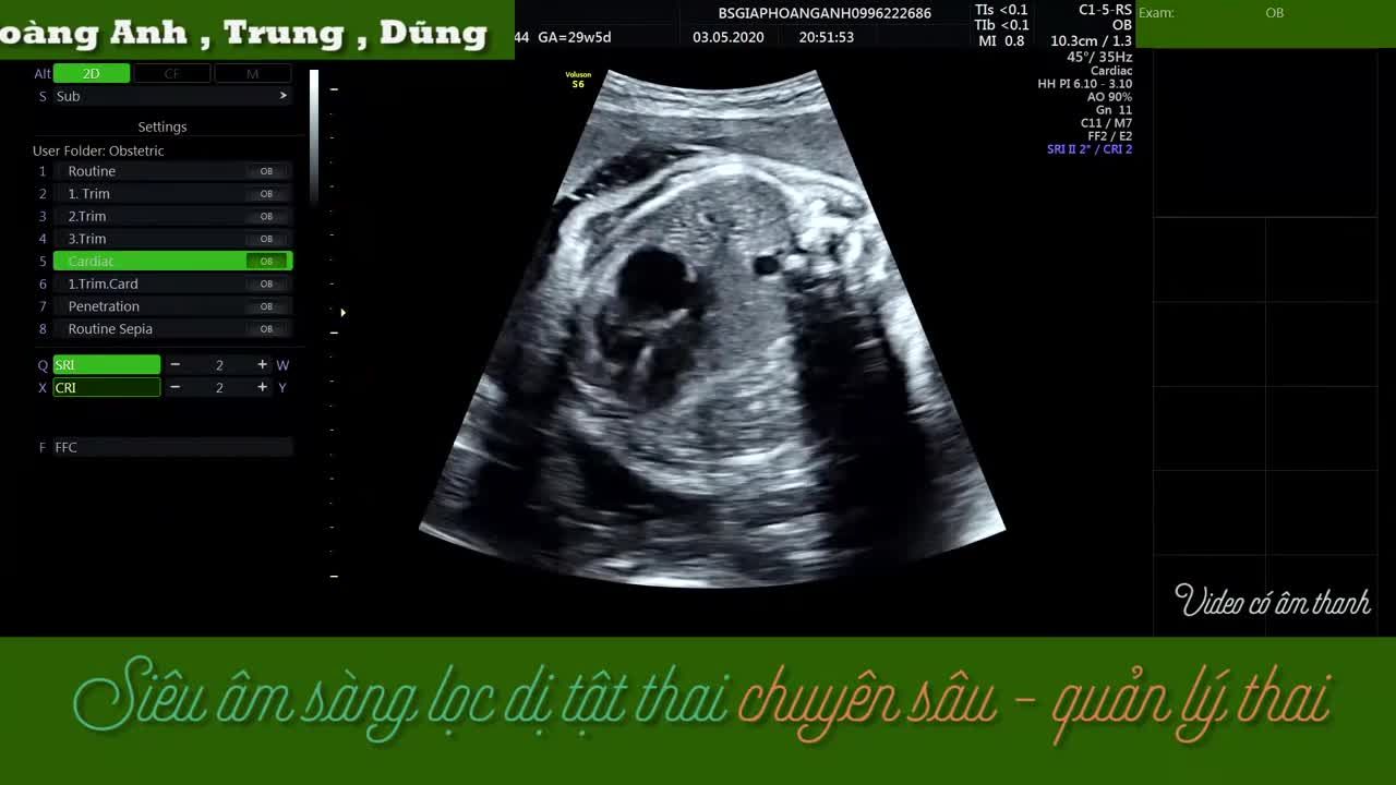 Thoát vị hoành thai 29w Siêu âm thai chuyên sâu: Hoàng Anh, Trung, Dũng.