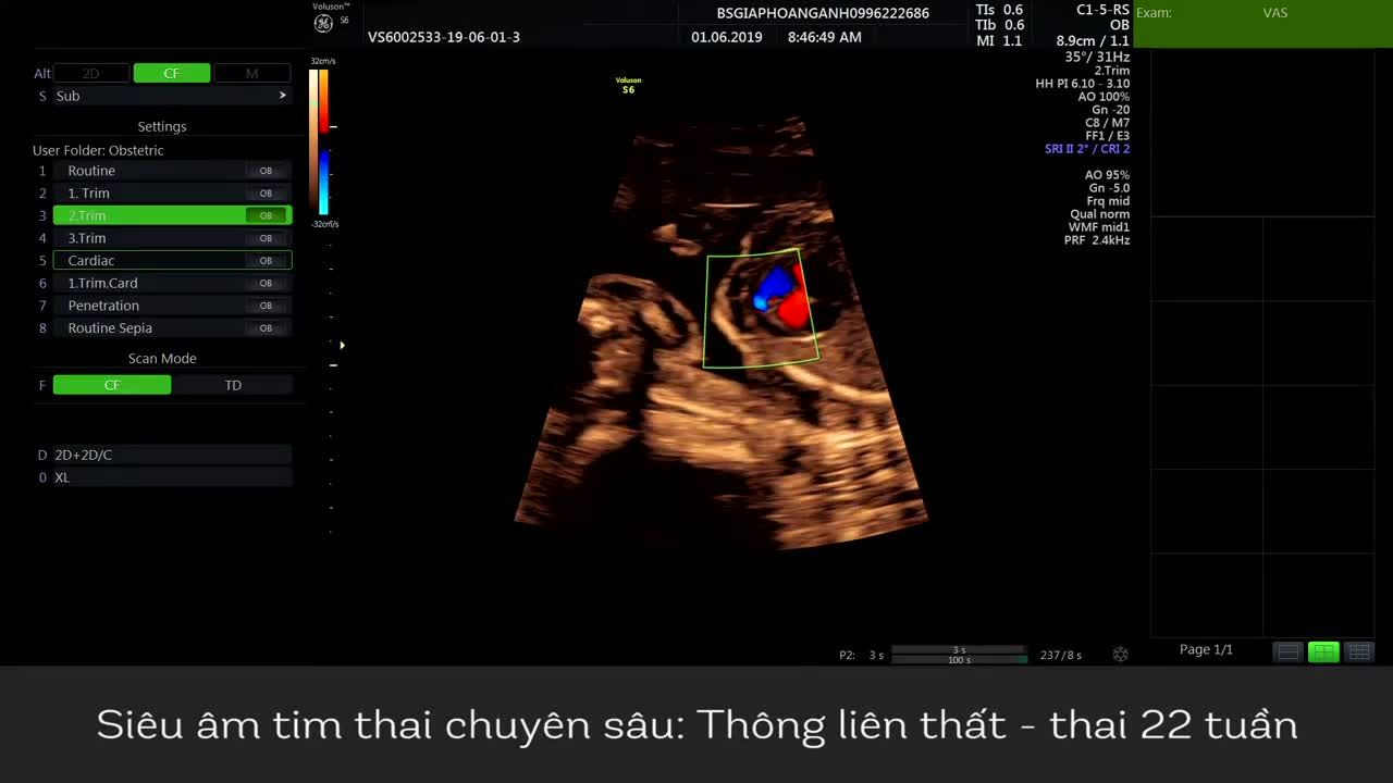 Thông liên thất tim thai - Bs Hệ thống PK Siêu âm thai Giáp Hoàng Anh phát hiện.