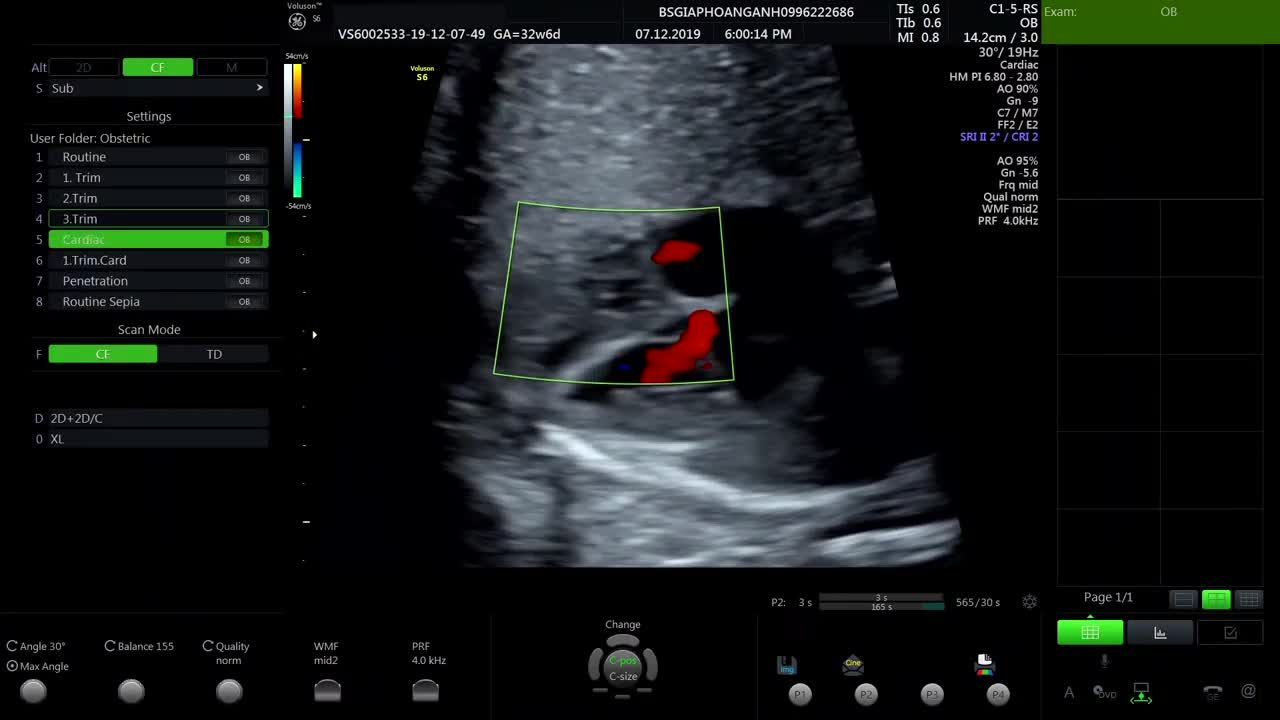 Thông liên thất tim thai phát hiện từ khi thai nhi còn rất nhỏ - Cảm ơn Bs Trung