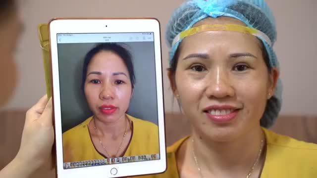 Tình trạng nào nên Nâng cung mày để cải thiện? Theo dõi video để hiểu thêm bạn nhé