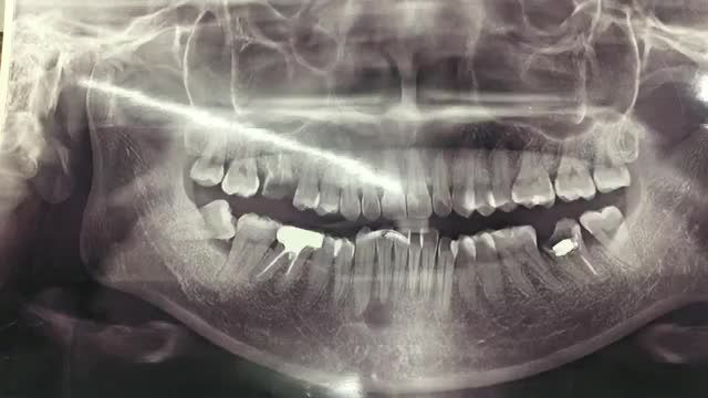 Trồng chân răng nhân tạo implant phục hình răng 37 cho chị Văn.