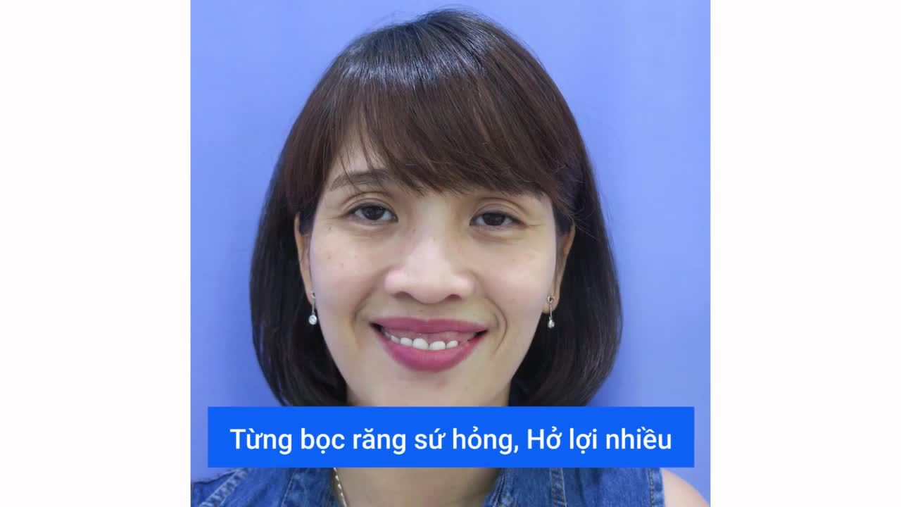 TỰ TIN NỞ CỤ CƯỜI CHỈ SAU 2 LẦN HẸN BỌC SỨ TẠI NHA KHOA QUỐC TẾ VIỆT ĐỨC