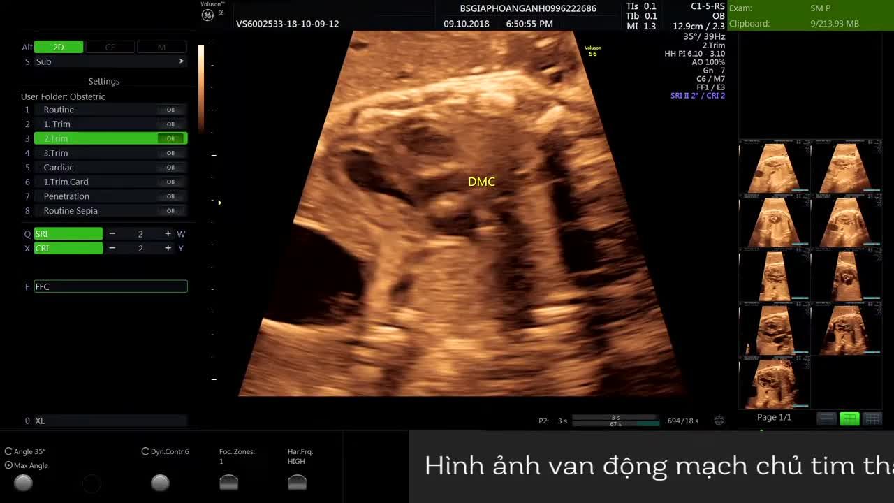 Van động mạch chủ thai nhi - Hệ thống PK siêu âm thai Bs Giáp Hoàng Anh.