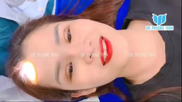 3 NĂM NÂNG MŨI, KHÁCH HÀNG QUAY TRỞ LẠI CẮT MÍ