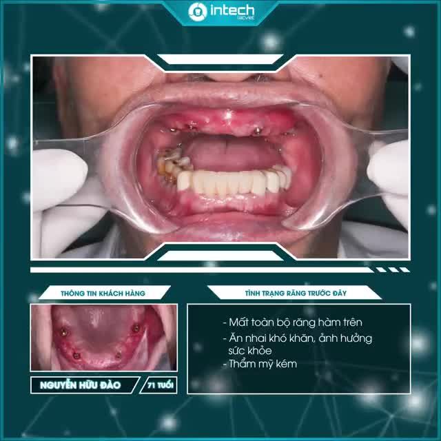 ĂN NHAI KHỎE KHOẮN CHỈ NHỜ TRỒNG RĂNG TOÀN HÀM ALL-ON-4