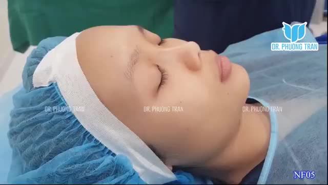 BÁC SĨ PHÂN TÍCH KẾ HOẠCH THAY ĐỔI DÁNG MŨI CHO BẠN GÁI MŨI THẤP, NGẮN