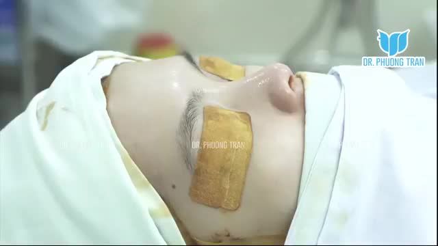 BÁC SĨ PHÂN TÍCH VÀ NÂNG MŨI BẰNG CHẤT LIỆU SỤN SƯỜN KẾT HỢP SURGIFORM