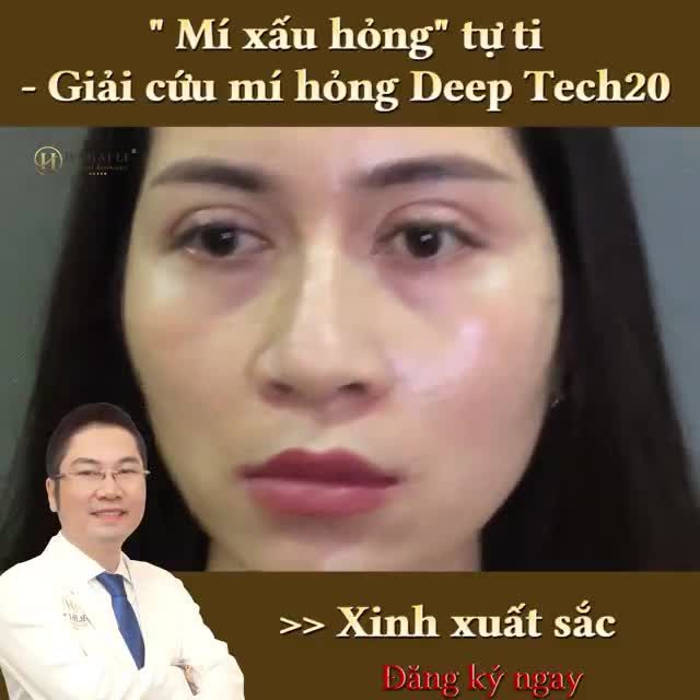Bạn đang gặp phải vấn đề nào về nếp mí của mình