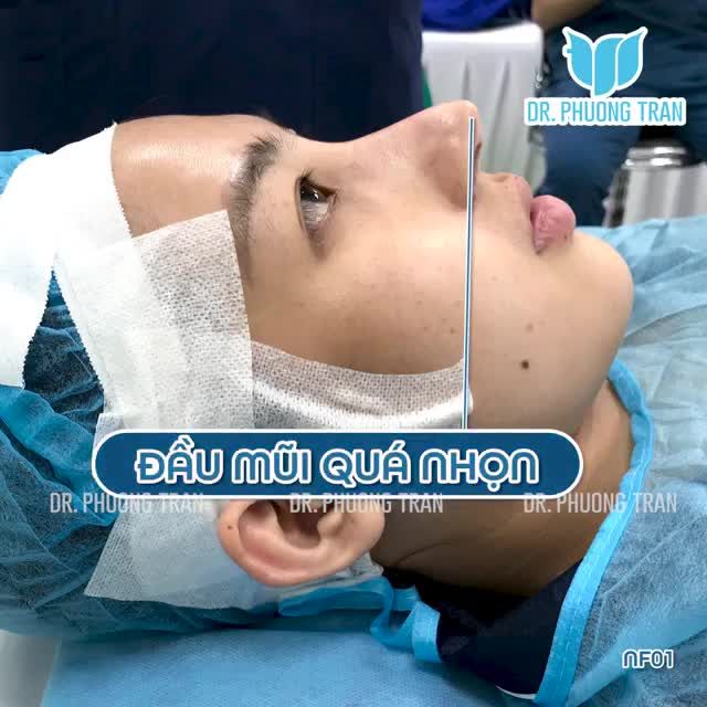 BẠN MUỐN NÂNG MŨI CAO TÂY HAY THEO MỘT HÌNH MẪU NÀO ĐÓ?