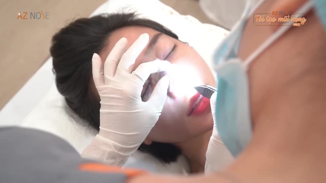 Bất ngờ với dáng mũi Thùy Linh sau khi tháo nẹp