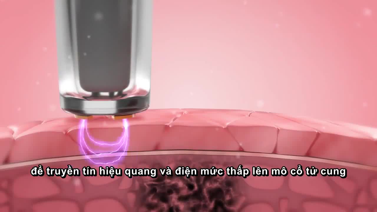 Bệnh viện Phụ Sản Hà Nội chính thức triển khai sàng lọc ung thư cổ tử cung bằng phương pháp TruScreen