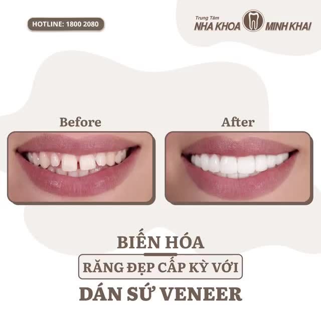 Biến hóa răng đẹp cấp kỳ với dán sứ Veneer