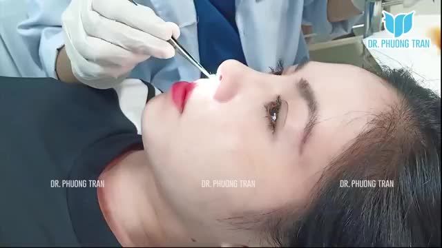 "BIẾT NÂNG MŨI SỤN SƯỜN MÀ NHẸ NHÀNG, KHÔNG ĐAU THÌ CHỊ ĐI LÀM LẠI LÂU RỒI"