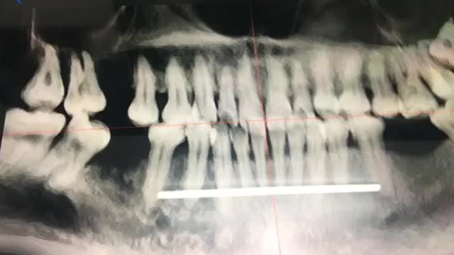 Ca cấy 2 chân răng nhân tạo Implant cho chị Sen tại Nha Khoa Thuỳ Anh