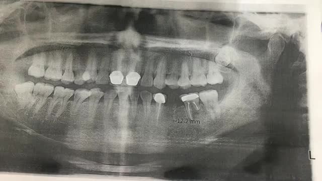 Ca cấy chân răng nhân tạo implant R35 cho khách hàng.