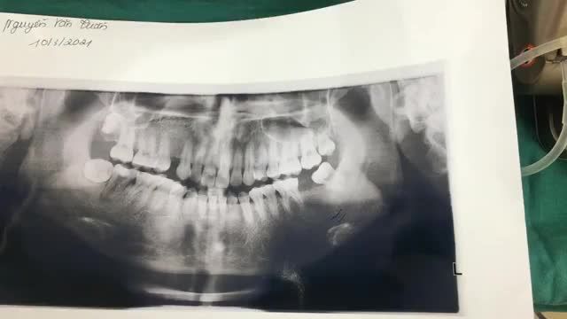Ca cấy ghép chân răng nhân tạo implant 37