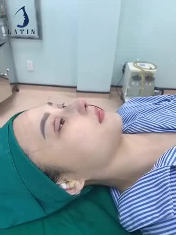 Ca cuối cùng trong ngày - combo mũi tái cấu trúc sửa lại và cắt mí 4D cho em gái đã từng nâng mũi 2 lần ở nơi khác nhưng không thành công