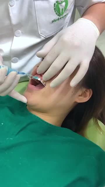 CA DÁN SỨ VENEER 100% KHÔNG MÀI RĂNG GỐC TẠI NHA KHOA GIA ĐÌNH