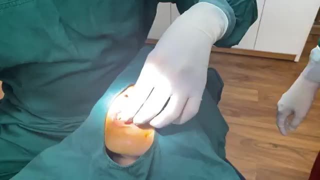 Ca điều trị cười hở lợi chỉ trong 30 phút cho bạn Vân tại nha khoa Thùy Anh