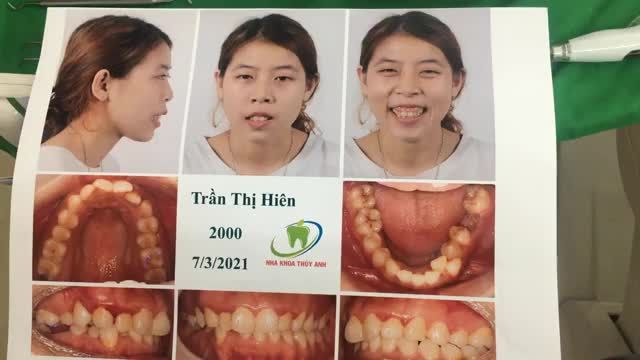 CA GẮN MẮC CÀI CHỈNH NHA
