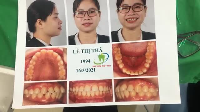 Ca gắn mắc cài hàm dưới cho bạn Thà tại Nha Khoa Thuỳ Anh.