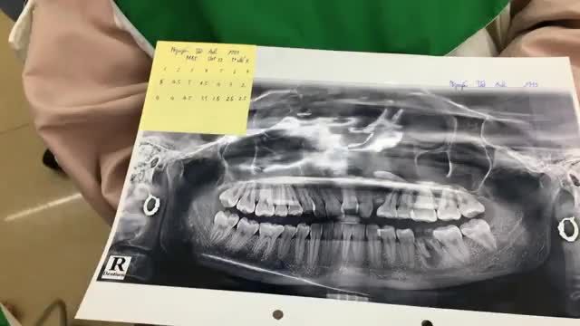 Ca gắn mắc cài hàm trên cho bạn  khách hàng tại Nk Thuỳ Anh.