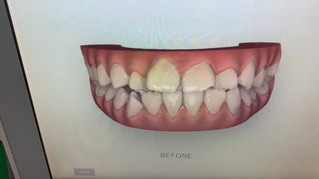 Ca gắn mắc cài thứ 4 trong ngày cho bạn Nhung điều trị răng khấp khểnh.