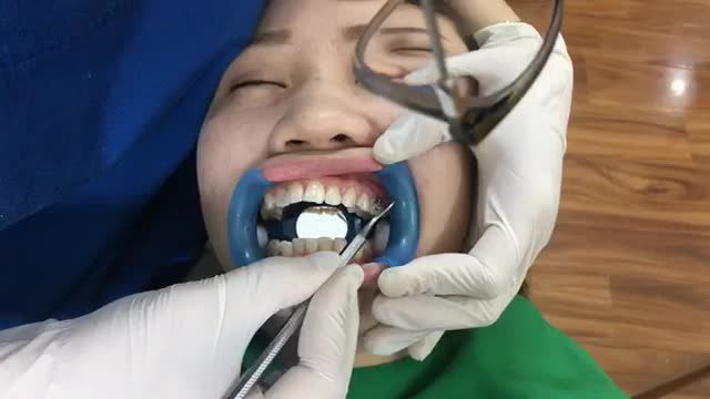 Ca gắn mắc cài thứ 4 trong ngày. Cùng theo dõi quá trình gắn mắc cài điều trị hô cho bạn khách hàng tại Nha Khoa Thuỳ Anh