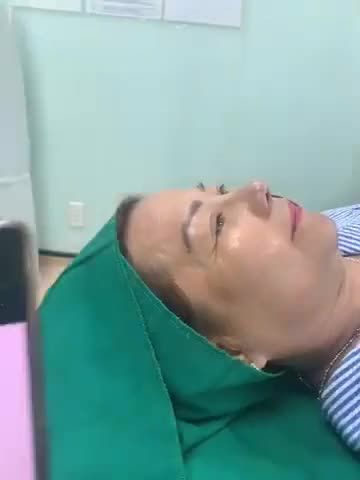 Ca mũi bán cấu trúc thu gọn đầu mũi dáng nhẹ nhàng tự nhiên đã có kết quả rồi đây ạ.