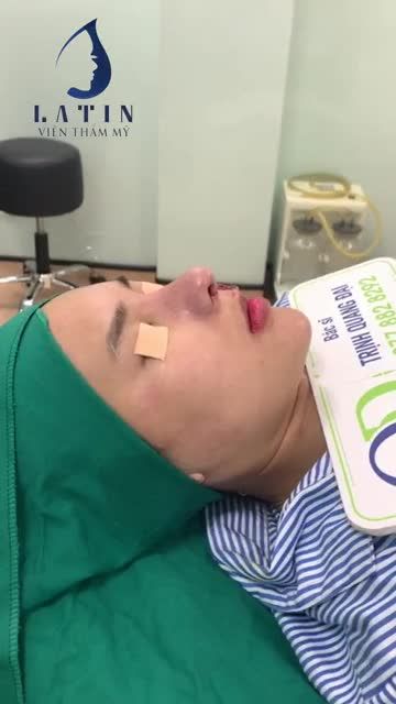 Ca mũi tái cấu trúc - sửa lại mũi đã từng nâng 6 lần ở cơ sở khác không thành công.