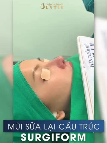 Ca sửa mũi tái cấu trúc sửa lại lần 3 với tình trạng đầu mũi bị lộ nhiều, sụp trụ mũi, lộ sóng, gồ đã có kết quả cho cả nhà cùng ngắm đây ạ