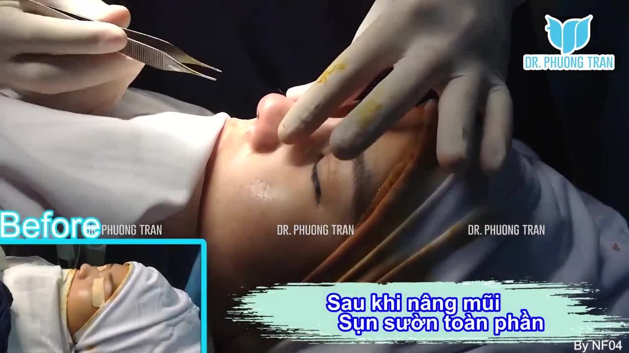 CA SỤN SƯỜN CHO MŨI SỬA LẠI ĐẸP NGOÀI MONG ĐỢI