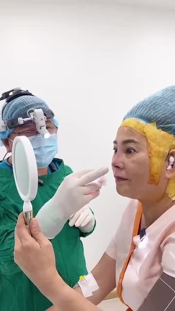 Ca tái tạo mũi cho khách hàng 7X từng 3 lần sửa mũi bị hỏng