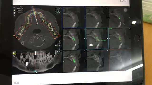 Ca trồng răng implant thứ 3 trong ngày, trồng răng cho chú Chiều