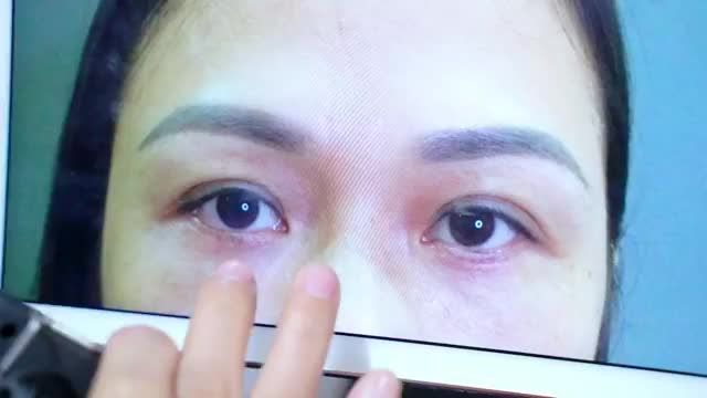 Cận cảnh kết quả cắt mí trên + dưới sau 7 ngày của Dr.Hải Lê. GIẢI MÃ tất cả câu hỏi xung quanh thẩm mỹ mắt ?