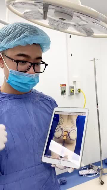Cận cảnh kết quả Nâng vòng 3 đẹp mĩ mãn bằng mỡ tự thân