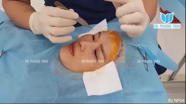 CẬN CẢNH MỘT CA CẮT MÍ, TẠO MẮT 2 MÍ TỰ NHIÊN