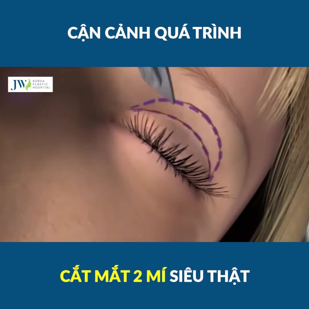 CẬN CẢNH QUÁ TRÌNH CẮT MẮT 2 MÍ SIÊU THẬT