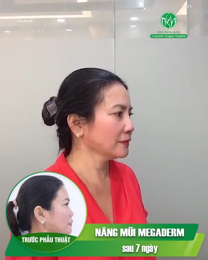 CẬP NHẬT THÊM MỘT KẾT QUẢ SAU NÂNG MŨI MEGADERM 7 NGÀY